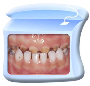 图中所见是患有幼儿严重蛀牙的乳齿。