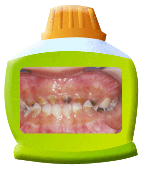 图中所见是上下排牙齿，前牙和后牙都患有幼儿严重蛀牙。